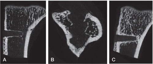 Figure 2. MicroCT results. A. POGLICO-SHS-UNTR tibia (birch nail, no bisphosphonate). B. POGLICO-SCS-UNTR tibia (birch screw, no bisphosphonate). Note the screw-shaped layer of new bone indicating the implant surface. C. POGLICO-SHS-ALN+ tibia (birch nail, bisphosphonate-treated). Note the increased thickness of the surrounding bone.