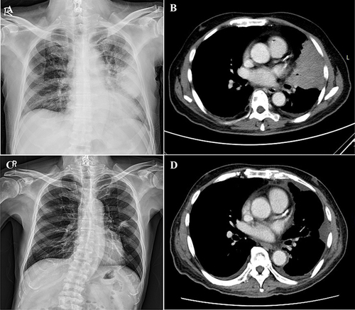 Figure 1 Radiographic findings before and after dacomitinib treatment. (A) Chest X-ray showed a mass-like opacity in the left lung field. (B) CT scan displayed a 7×7 cm mass in the left upper lobe, with enlarged contralateral mediastinal lymph nodes and evidence of multiple bony metastases. (C) Chest X-ray and (D) CT scan revealed a reduced lung tumor size in the left upper lobe after dacomitinib therapy.