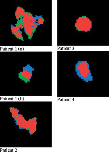 Figure 2. Segmented tumors in patients 1–4 using region growing. Patient 1 presented two lesions (a and b). Segmentation was performed in images obtained both during breath hold (BH blue) and free breathing (FB, green). The intersection of the regions is given in red.