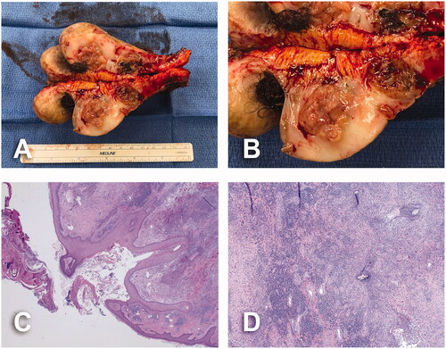 Figure 5. Pathology assessment of case No. 1. (A) Cross section of surgical specimen. Multiple, ragged, necrotic, hair-bearing lesions ranging from 0.1 × 0.1 × 0.1 cm to 6.5 × 5.2 × 4.3 cm, spanning the skin surface. (B) Details of necrotic, hair-bearing intralesional cavities. (C) Widened hair follicle surrounded by dense inflammatory process and dermal fibrosis, and overlying scale crust; 20× magnification. (D) Scattered hair shafts within a fibrotic dermis and dense acute and chronic inflammation; 40× magnification.