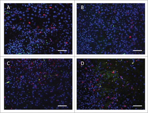 Figure 3. Representative fluorescent IHC analysis shows lymphocyte infiltration in the brain tumor and the corresponding lymphocyte population changes (particularly Treg and CTL populations). (A) Untreated brain tumor; (B) brain tumor treated with FUS-induced BBB opening; (C) brain tumor treated by IP IL-12 administration; (D) combined FUS with IL-12 administration, showing the enriched CTL infiltration and CTL/Treg ratio increase. Green: CD4+CD25+ lymphocytes (Treg); Red: CD3+CD8+ lymphocytes (CTL); Blue: DAPI-stained cell nucleus. Bar = 50 μm.
