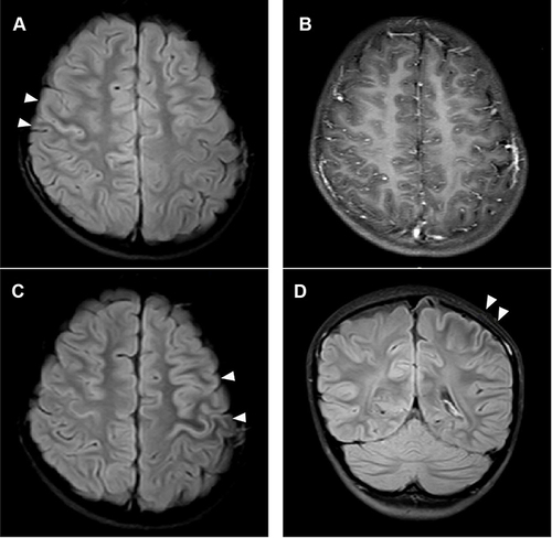 Figure 1 A 10-year-old girl with a relapsing MOGAD, presented with seizures at onset. (A) Axial T2-weighted fluid-attenuated inversion recovery(FLAIR) image of the brain shows cortical encephalitis(arrowheads) located in the right frontal and parietal lobes. (B) Axial T1 enhanced image shows the lesion with no obvious enhancement. Seizures emerge nearly three months later. The previous cerebral abnormalities resolve on MRI, another cortical lesion(arrowheads) affecting the contralateral frontal and parietal lobes is found on axial (C) and coronal (D) T2-FLAIR images.