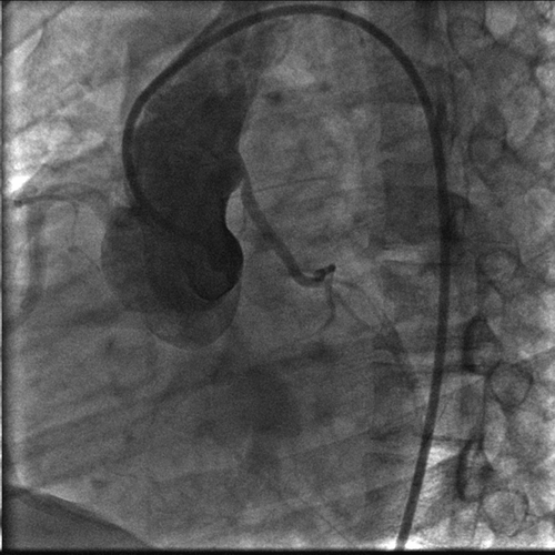 Figure 1 Aortic root with re-implanted LMT. Bending of LMT at the origin.