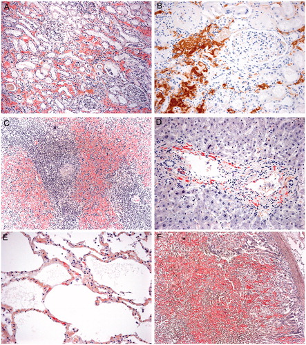 Figure 1. Leukocyte chemotactic factor 2 amyloidosis. (A) Uptake of Congo red by amyloid deposits in the renal cortex (original magnification ×100). (B) Reactivity of interstitial amyloid deposits with an anti-LECT2 antibody (immunoperoxidase technique, ×200). (C) Extensive amyloid deposition within the red pulp of the spleen (Congo red stain, original magnification ×100). (D) Globular pattern of amyloid deposition within the portal tract of the liver (Congo red stain, original magnification ×200). (E) Amyloid deposition in the pulmonary septa (Congo red stain, original magnification ×400). (F) Dense amyloid deposition in the cortex and medulla of the adrenal gland (Congo red stain, original magnification ×100).