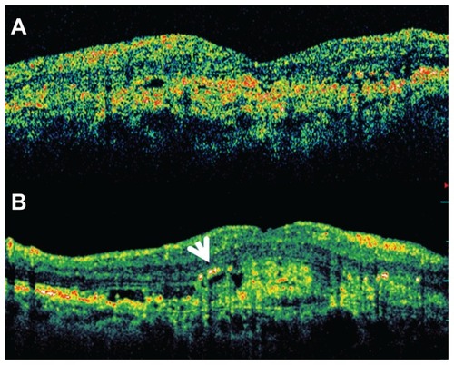 Figure 1 (A). Macular horizontal line scan by time domain (TD) OCT. (B) Macular horizontal line scan by spectral domain (SD) OCT. The comparison between the two OCT tools points out that hard exudates (white arrow) are visualized only by the SD device, where also intraretinal fluid cysts appear more evident and numerous.