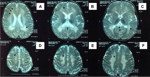 Figure 3 Axial T2-weighted brain MRI from patient P9.