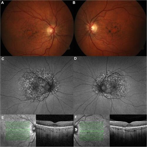 Figure 2 PPS-associated retinopathy.