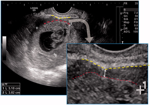 Figure 5. Measurement of minimum thickness of uterine lower segment myometrium: the hypoechoic myometrial layer (double-headed arrow) between the outer edge of the chorion (lower dotted line) and the inner edge of the uterine serosa (upper dotted line) was taken for measurement.