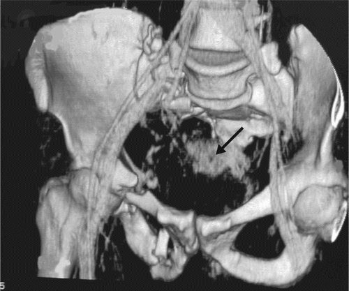 Figure 2. CT-reconstruction of an unstable pelvic fracture with injury to the lateral sacral artery (arrow).