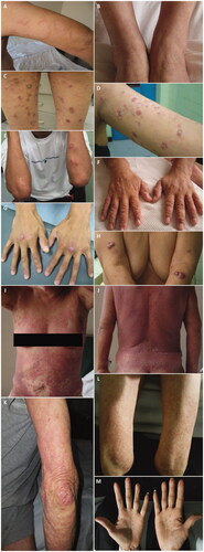 Figure 1. Types of ATLL skin lesions: patch-type (A, B); plaque-type (C,D); multipapular-type (F); tumoral nodule-type (E,G,H); erythrodermic-type (I, J); and mixed-lesions (K,L,M).