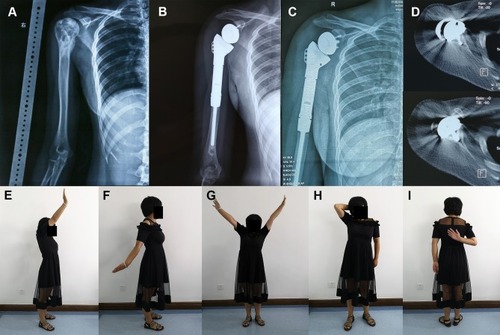 Figure 4 A 24-year-old female patient with osteosarcoma underwent RSA following en bloc resection of the right proximal humerus.Notes: (A) Preoperative X-ray image; (B) postoperative X-ray image 3 months after surgery; (C) postoperative x-ray image 16 months after surgery; (D) the transaxial CT scanning of right shoulder joint obtained 10 months after surgery showed osteointegration; (E–I) at the last follow-up, the patient recovered satisfactory contour and function of the shoulder.Abbreviation: RSA, reverse shoulder arthroplasty.