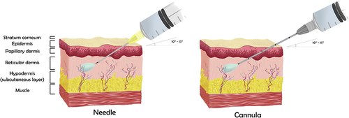 Figure 1 The intradermal with needle and with cannula application techniques.