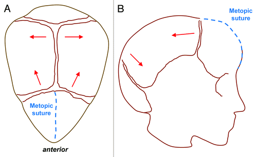 Figure 4. Metopic Synostosis. Top view (A) and lateral view (B) schematics demonstrating trigonocephaly, or a triangular keel-shaped head. Compensatory calvarial growth (red lines) can lead to widening and increased height in the parietal region due to compensatory growth in a posterior direction following premature fusion of the metopic suture (blue dashed line).