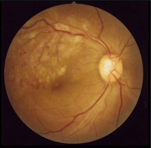 Figure 1 Fundus photo at the initial visit (right eye).