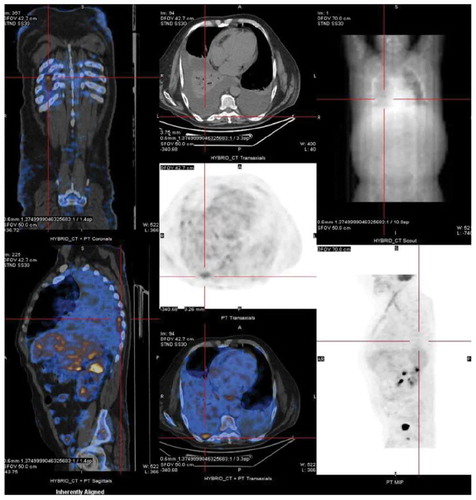 Figure 2. Positron emission tomography showing a focus of moderate hypermetabolism in the posterior region of the right pleura
