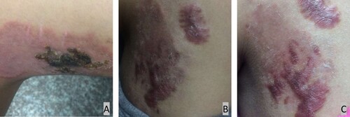 Figure 1. A, Cutaneous lesion on the left observed in September 2018 showing an erythematous plaque; B, Cutaneous lesion on the left observed in March 2019; C, Cutaneous lesion on the left observed in April 2019 showing a crusty surface and scarring.