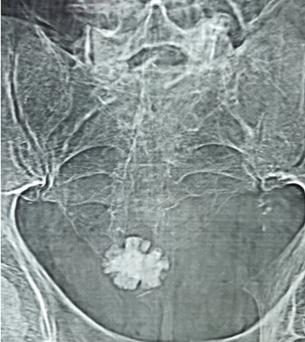 Figure 1 X-ray KUB showing large bladder stone.