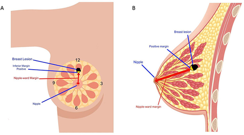 Figure 2 (A) Frontal view of the breast highlighting the cancer (black mass) at 12’o clock in relation to the nipple with inferior margin positive (yellow) demonstrating cancer spread in the nipple-ward direction. (B) A lateral view of the breast highlighting the tumor (black mass) at 12 o’clock with a positive inferior margin (yellow) illustrating cancer spread in the nipple-ward direction.