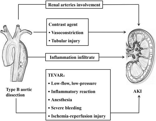 Figure 1. Potential mechanisms of AKI in type B aortic dissection patients.