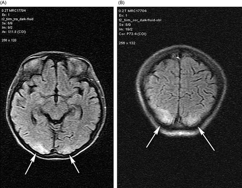Figure 2. (A) Cranial MRI showing irregular T2- and FLAIR-weighted lesions in bilateral cortical occipital lobes. (B) Coronal plane images of the lesions.Note: MRI, magnetic resonance images; FLAIR, fluid-attenuated inversion recovery.