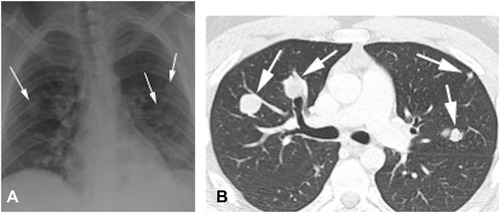 Figure 9 Pulmonary metastases. Same patient as Figure 8. (A) Chest radiograph showing multiple pulmonary masses and nodules predominantly in bilateral mid-zones. (B) Chest CT lung window settings showing multiple lung nodules in right-middle and left-upper lobes.