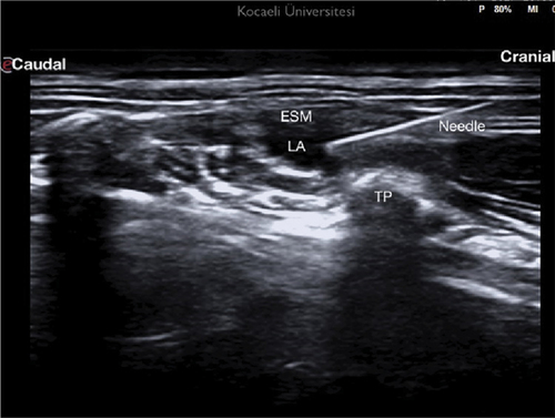 Figure 2. Spread of LA between erector spinae muscle and transverse process.