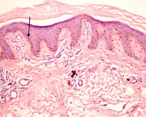 Figure 4 Pathological section showing pigmentation on the basal layer (arrow), and pigmentophages found in the dermis. No mucin deposition was noted (H&E, ×200).