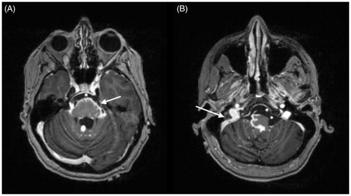 Figure 2. MRI brain, axial T1 post-contrast images: marked leptomeningeal enhancement at the base of the skull including along the midbrain (A) (arrow), surrounding the pons/medulla and along cranial nerves VII (B) (arrow). Brainstem enhancement in panel A represents involvement of pia-arachnoid with extension into Virchow–Robin spaces. Courtesy of Dr Fang Zhu, Chicago.