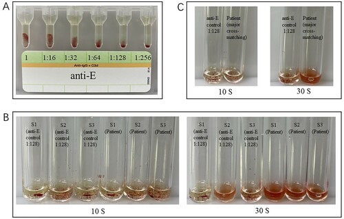 Figure 2. Representative results of pre-transfusion compatibility test using Polybrene method in a Chinese patient treated with DARA. The results were all negative, while IgG anti-E plasma showed a 2+ agglutination intensity. (A) Different agglutination intensity of E+ RBCs reacted with human IgG Anti-E diluted from 1:16 to 1:256 in IATs. (B) Antibody screening results (left three tubes: anti-E control, right three tubes: Patient S1 to S3 means 3 antibody screening cells). (C) Major cross-matching results (left: anti-E control, right: Patient).