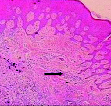 Figure 2. Mild inflammatory infiltration in the underlying connective tissue area (arrow).
