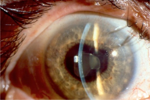 Figure 2 Enthesitis-related arthritis-associated acute anterior uveitis. Recurrent HLA-B27-associated anterior uveitis with hypopyon and extensive posterior synechiae. Courtesy of Dr JP Dunn, The Wilmer Eye Institute, The Johns Hopkins School of Medicine, Baltimore, MD.
