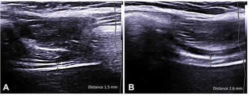 Figure 3 Ultrasound evaluation of diaphragmatic thickness.