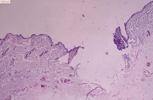 Figure 1 Histopathological view of the deep dermal burn model with hematoxylin-eosin staining shows the absence of the epidermal and dermal layers of the skin (HE staining, magnification 40x).
