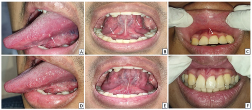 Figure 1 Clinical characteristics of Case 1. (A and B) On the first visit, the patient had several multiple yellowish-white ulcers on the lateral border of the tongue and floor of the mouth. (C) An elongated band-shaped erythematous lesion on the upper and lower anterior gingiva. (D–F) The lesions notably improved within a week.