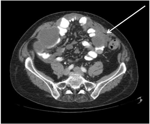 Figure 4. CT slice showing tumour ≥5 cm in diameter in jejunal regions. There are also large tumour masses present in the ileal regions. The right sided tumour is likely to be resectable.
