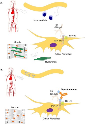 Figure 4 Mechanism of action of teprotumumab. (A) Evidence suggests that TED occurs due to upregulation of the TSH-R/IGF-1R complex consequential to pathogenic autoantibody (GD-IgG and TSI) stimulation of fibroblasts. Such activation leads to the production of glycosaminoglycans (eg, hyaluronan), and expansion of fat and muscle next to the eye.Citation2 (B) Teprotumumab attenuates pathogenic autoantibody-mediated stimulation of orbital fibroblasts, thereby inhibiting TSH-R signaling, and correcting active TED endpoints, including proptosis and diplopia.Citation35,Citation108 Modified from Douglas RS. Teprotumumab, an insulin-like growth factor-1 receptor antagonist antibody, in the treatment of active thyroid eye disease: a focus on proptosis. Eye (Lond). 2019;33(2):183–198. Creative Commons License and Disclaimer available from: http://creativecommons.org/licenses/by/4.0/legalcode.Citation2
