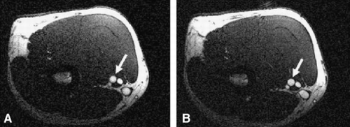 Figure 1. Cross‐sectional MR image through right ellbow perpendicular to brachial artery (arrows) acquired at A) baseline and B) at maximal reactive hyperemia post cuff release.