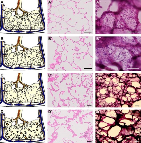 Figure 2 Schemas (A–D) and images of an ordinary H&E slide (A′–D′) and an H&E thick section (A″–D″) on possible progression of pulmonary emphysema.