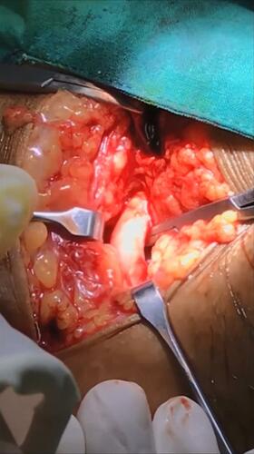 Figure 1 Right groin vertical incision to identify right common femoral artery and prepare for insert the vascular sheath.