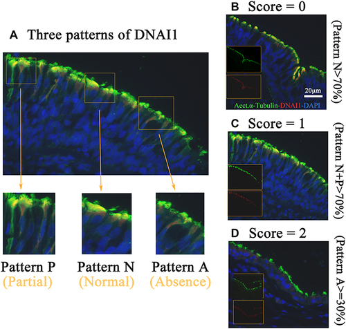 Figure 2 Three location patterns of DNAI1 expression and evaluated scores. (A) Three patterns of DNAI1 localization, normal, N; partial, P; absence, A, were observed in both control and AR groups under 400× magnification, scale bar 20 µm. (B–D) Semi-quantitative scoring system was used in five areas per paraffin section. Every individual section was assigned a score between 0 and 2.