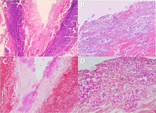 Figure 2 Pathological images of skin biopsy of the patient with gangrenous herpes zoster complicated with candida infection. (A) HE staining (×40). (B) HE staining (×100). (C) PAS staining (×40). (D) PAS staining (×100).