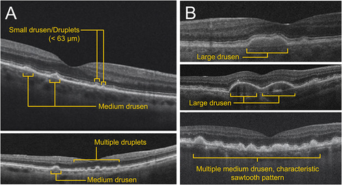 Figure 2 Stages of AMD as observed via OCT. (A) Early AMD. (B) Intermediate AMD.