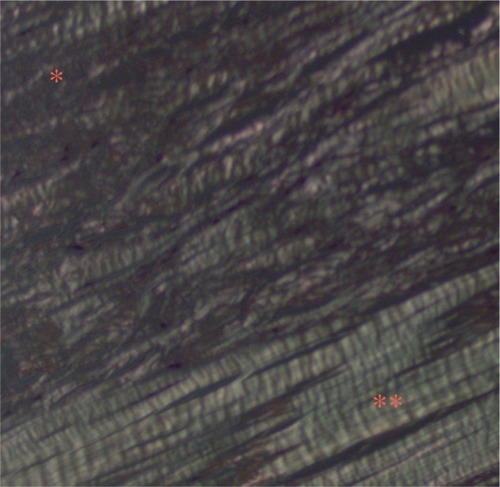 Figure 4 Polarized light microscopy shows areas of fragmentation of the collagen and loss of normal polarization pattern (*).