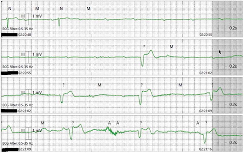 Figure 1. Telemetry showing ventricular standstill of 10–11 seconds with EVBs.