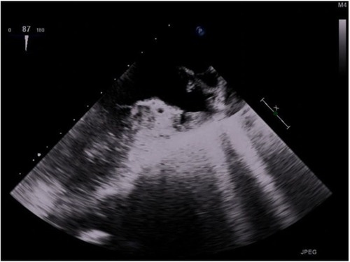 Figure 3 Transesophageal echocardiography (TEE) view with no thrombus in left atrium after thrombolysis.