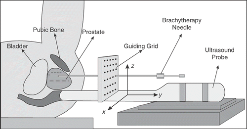 Figure 1. Needle insertion during prostate brachytherapy. [Color version available online.]