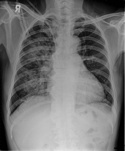 Figure 1. A chest X-ray on admission showing diffuse infiltration in the right lung field.
