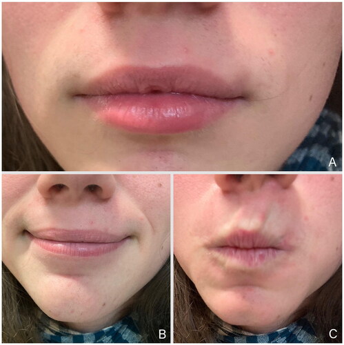 Figure 4. Postoperative pictures three months after surgery show good esthetic (A) and functional results (B, C).