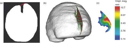 Figure 5. Evaluation of the displacement field of the cut for 3D retraction modeling. (a) Whole-brain region segmented out from the third iMR image, with segment (in red) defining the angle of the displacement field of the right lip. (b) Surface mesh built from the segmented third iMR image, cut mesh (Figure 3e) (in red), and displacements of cut intersections (in green). (Displacements go from right to left in the figure.) (c) Cut mesh (Figure 3e) with color levels corresponding to the magnitude of the displacement field of the right lip.