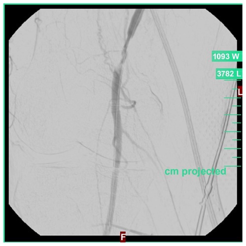 Figure 5 Detection of a high-grade insertion stenosis of the bypass as the presumed cause of the occlusion.